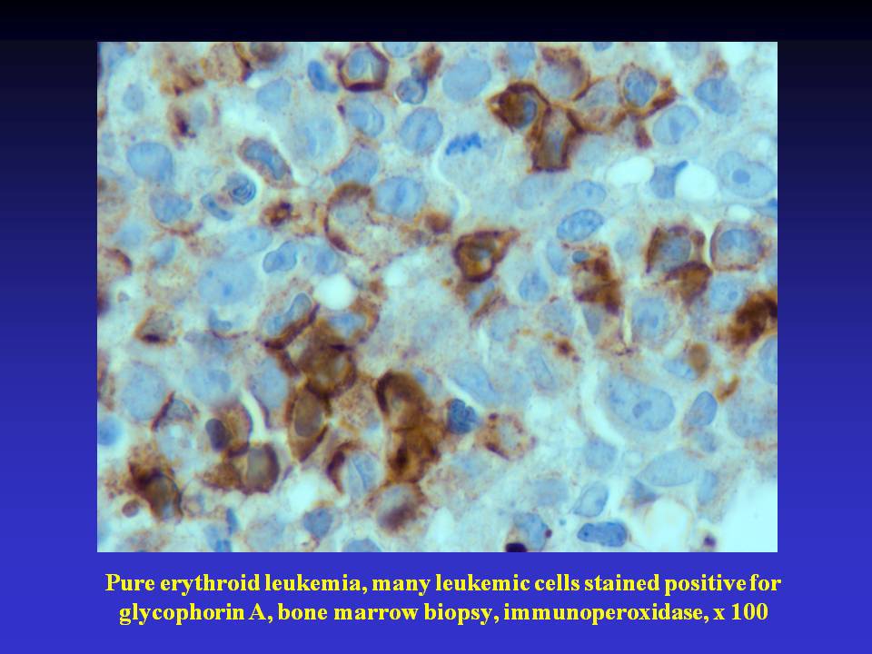 Fig. 7. Pure erythroid leukemia, many leukemic cells stained positive for glycophorin A, bone marrow biopsy, immunoperoxidase, x 100